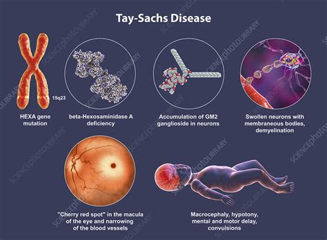 Tay-Sachs disease, illustration - Stock Image - F034/4371 - Science Photo Library