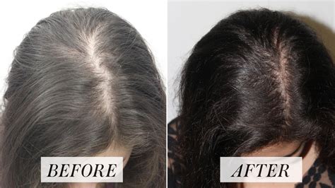 Platelet Rich Plasma Treatment for Hair Loss: Here's What to Know | Allure