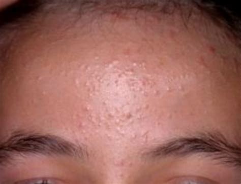 Bumps on Forehead, not Pimples, under Skin, Tiny, Large, Lumps, Zits, Red, White, Get Rid ...