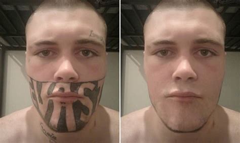 DEVAST8 tattoo man left with blackheads from laser removal | Daily Mail ...