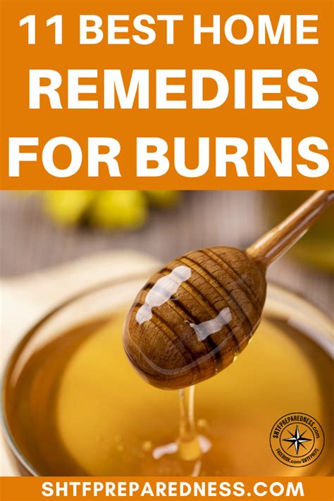 11 Best Home Remedies for Burns | Recipe | Home remedies for burns ...