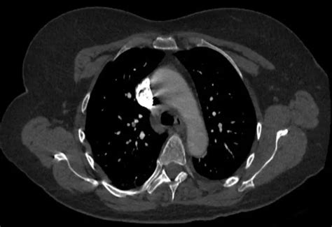 Subsegmental pulmonary embolism: Prognosis and Treatment