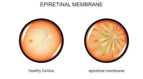 Epiretinal Membrane Oct