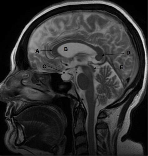 Sagittal T2 weighted magnetic resonance image of the brain | The BMJ