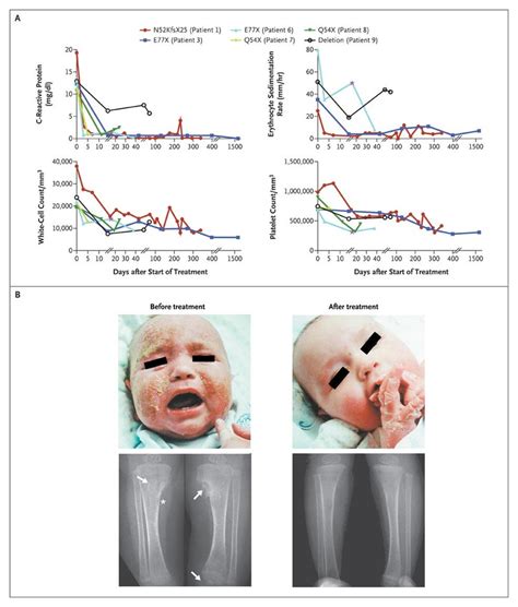 An Autoinflammatory Disease with Deficiency of the Interleukin-1–Receptor Antagonist | NEJM