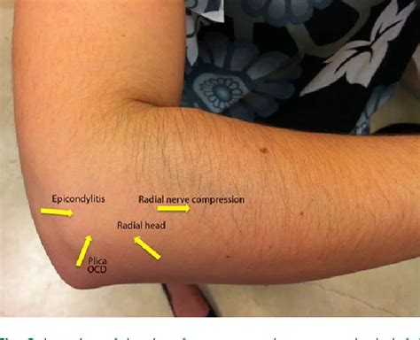 [PDF] Lateral epicondylitis of the elbow | Semantic Scholar