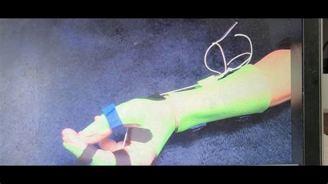 watch how a tenodesis splint facilitates function - YouTube