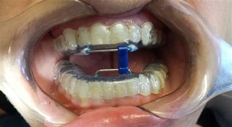 Mandibular Advancement Device: Everything You Need to Know | Healthtian