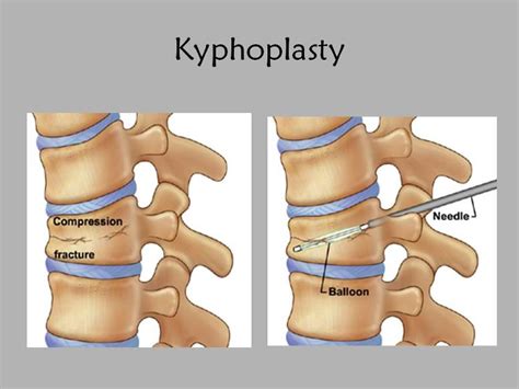 How Long Is the Kyphoplasty Recovery Time? | New Health Advisor