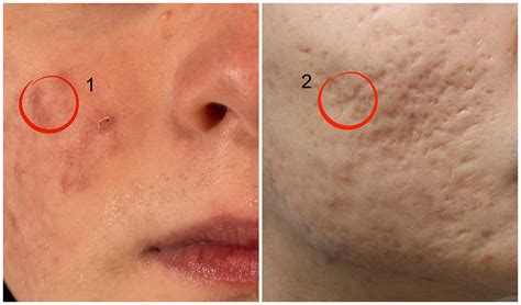 acne lesion - pictures, photos