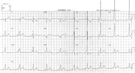 Pre-excitation syndromes • LITFL • ECG Library Diagnosis