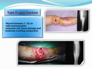 Open Fracture Antibiotics prophylaxis | PPT