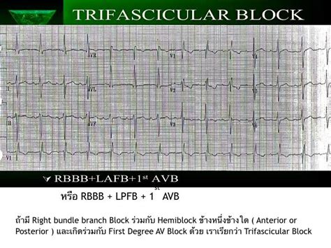 Trifascicular Block คือ