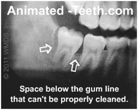 Gum disease around wisdom teeth. | Tooth loosening | Periodontitis
