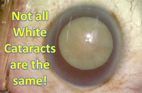 White Cataracts: They are not all the same! – Cataract Coach