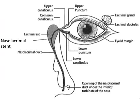 Lacrimal Obstruction — Dr Ye Chen · Oculoplastic Surgeon & Ophthalmologist · Melbourne