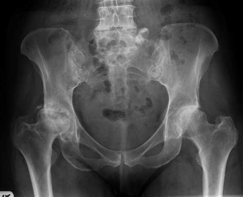 Hip Pain in Adults: Differential Diagnoses and Diagnostic Imaging — NP ...