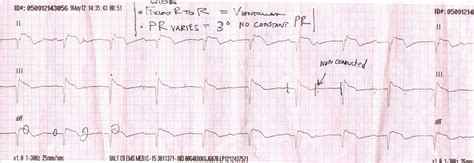 ECGs for EMS: The Deceptive Ears of a Rabbit