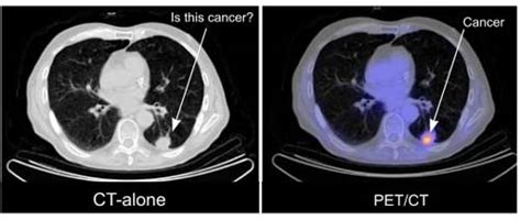 Pet Scan Images Lung Cancer