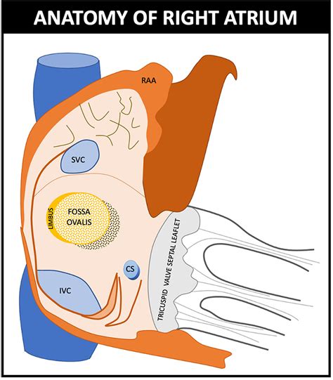 Transseptal puncture: Review of anatomy, techniques, complications and challenges, a critical ...