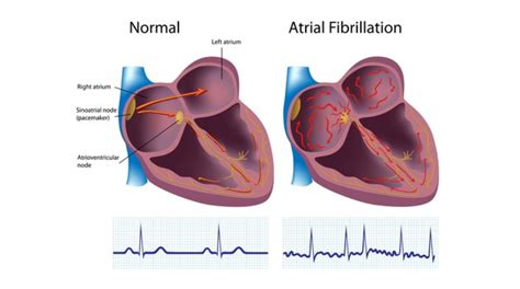 Tens of millions of Americans may have AFIB and not know it | Lovelace ...