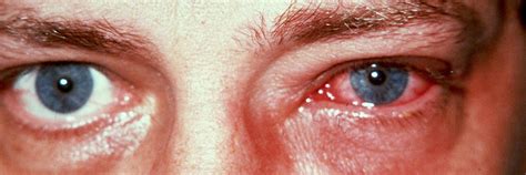 Eye Infections – Dr. Faramarz Davidi