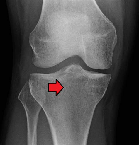 Fracture of the Proximal Tibia