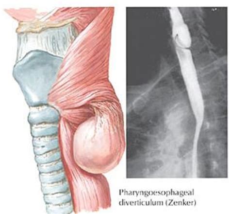 Figure 1 from Surgical treatment of Zenker’s diverticulum. Is the open ...