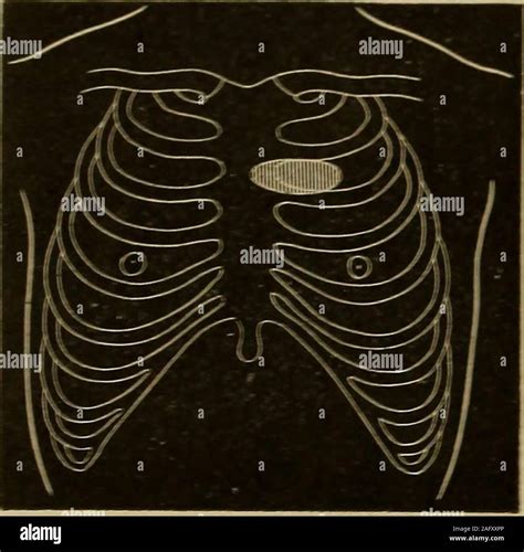 Pulmonary atresia hi-res stock photography and images - Alamy