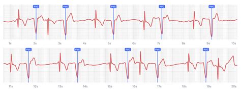 What Ventricular Bigeminy Looks Like on Your Watch ECG | Qaly