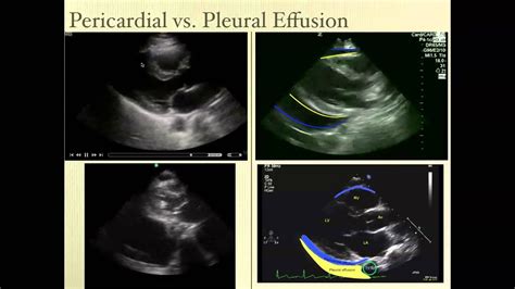 Pericardial Effusion Ultrasound Review - YouTube