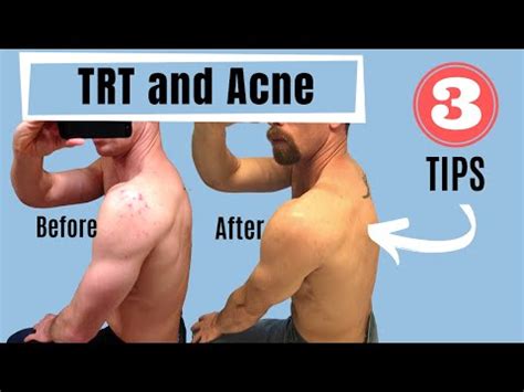 TRT and Acne - 3 Tips (Testosterone Replacement Therapy) - YouTube