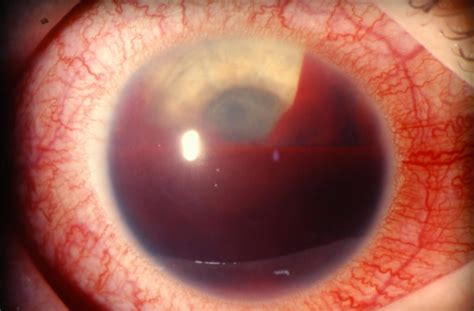 Hyphema causes, symptoms, grading, complications, recovery & treatment