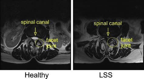 Facet joint osteoarthritis in lumbar spinal stenosis: histological evaluation of cellular ...