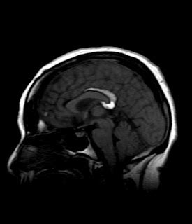 Pericallosal Lipoma-MRI - Sumer's Radiology Blog