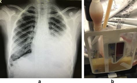 a: Chest radiograph on presentation shows left sided pleural effusion;... | Download Scientific ...