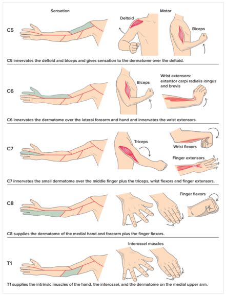 Cervical Radiculopathy - Physiopedia