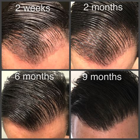 Hair Transplant Timeline | Marc Dauer, MD Hair Transplant Doctor Los Angeles