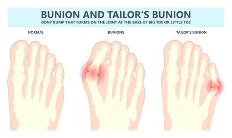 Tailor's Bunion | How to treat a Tailor's Bunion (Pinky Toe Bunion)