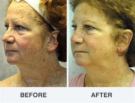 Seborrheic Keratoses in Phoenix & Scottsdale, AZ - Suddenly Slimmer Med Spa