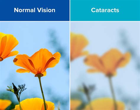 Cataracts | Causes, Symptoms, & Treatment | Acuity Eye Group