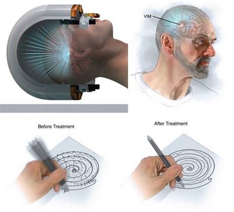 Focused Ultrasound to Treat Essential Tremor - SeattleNeurosciences.com