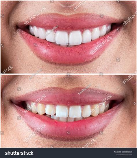 Before After Picture Ceramic Restorations On Stock Photo 2293190039 | Shutterstock