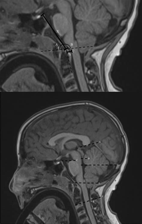 [Upper panel] Mid-sagittal T1 MR sequence illustrating morphometric... | Download Scientific Diagram