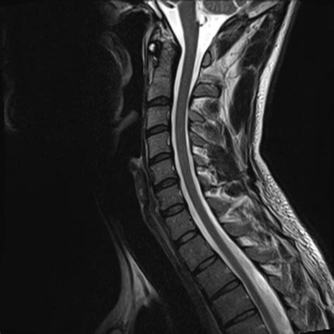 Normal cervical spine MRI | Image | Radiopaedia.org