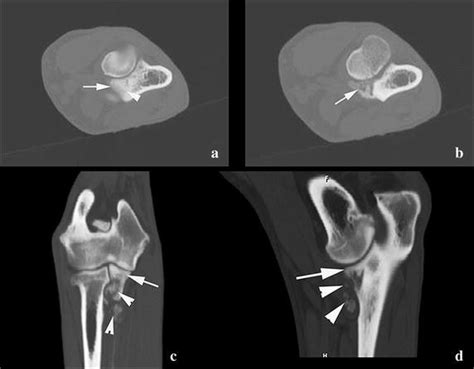 A chondroblastic osteosarcoma of the coronoid process mimicking a fragmented coronoid process in ...