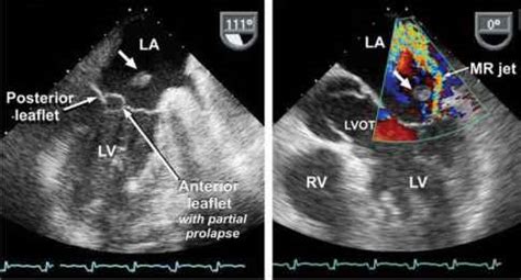 Linear Echodensity In Right Atrium - Echocardiography