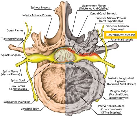 Lateral Recess Stenosis: Anatomy, Causes, Symptoms, Diagnosis, and ...