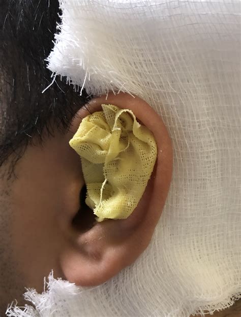 Mastering Minor Care: Auricular Hematoma — Taming the SRU