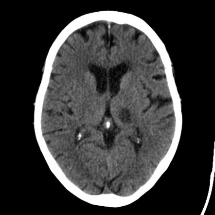 Lacunar Infarct Mri